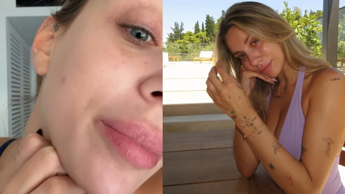 Γαρυφαλλιά Καληφώνη: Η πάθηση που την ταλαιπωρεί – «Αν έρθω μπροστά στην κάμερα θα τρομάξετε…»