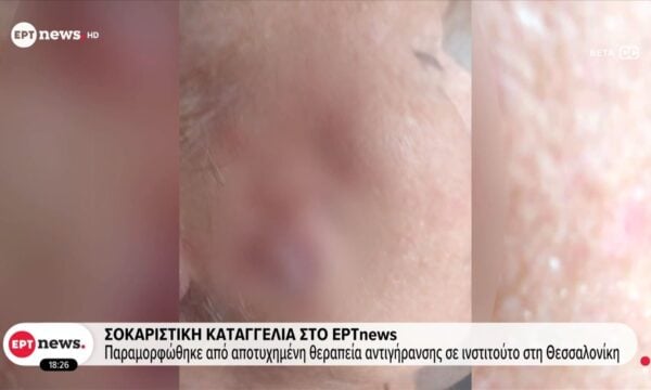 Σοκαριστική καταγγελία στο ΕΡΤnews – Παραμορφώθηκε από αποτυχημένη θεραπεία αντιγήρανσης σε ινστιτούτο στη Θεσσαλονίκη