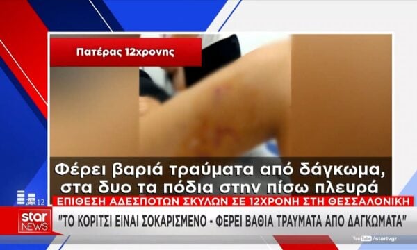 «Το κορίτσι είναι σοκαρισμένο»: Στο STAR ο πατέρας της 12χρονης που υπέστη επίθεση από σκύλους στη Θεσσαλονίκη
