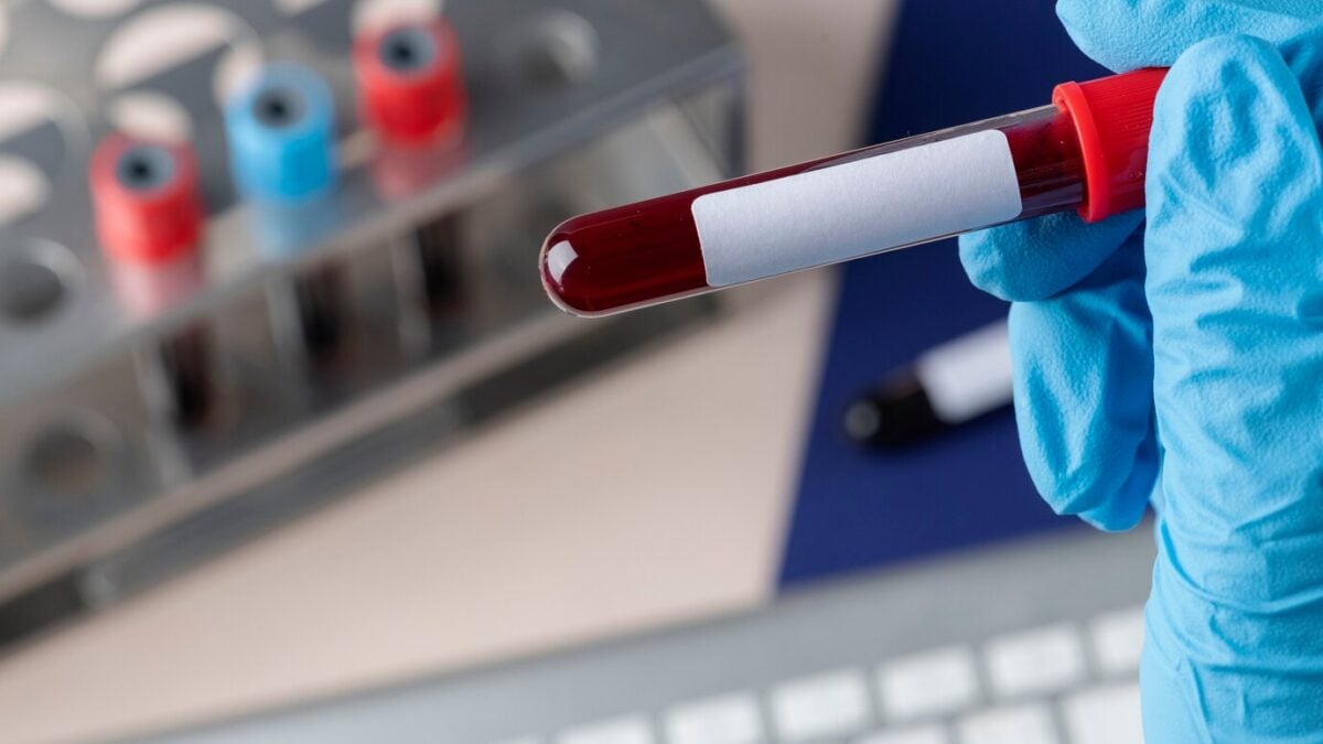 ΕΚΠΑ: Θεραπευτική πλασμαφαίρεση – η διαδικασία, οι ενδείξεις, οι ανεπιθύμητες ενέργειες 1 ΕΚΠΑ: Θεραπευτική πλασμαφαίρεση – η διαδικασία, οι ενδείξεις, οι ανεπιθύμητες ενέργειες