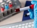 ΕΚΠΑ: Θεραπευτική πλασμαφαίρεση – η διαδικασία, οι ενδείξεις, οι ανεπιθύμητες ενέργειες