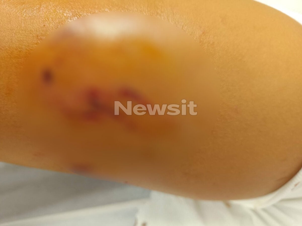 Θεσσαλονίκη: Αγέλη αδέσποτων σκυλιών τραυμάτισε 12χρονη – «Είναι σοκαρισμένη, δεν έχει ηρεμήσει», λέει ο πατέρας της
