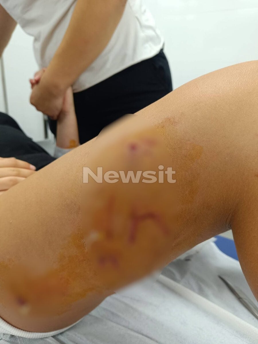 Θεσσαλονίκη: Αγέλη αδέσποτων σκυλιών τραυμάτισε 12χρονη – «Είναι σοκαρισμένη, δεν έχει ηρεμήσει», λέει ο πατέρας της