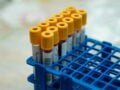 Εγκεφαλικό πριν από τα 60: Μελέτη συνδέει την ομάδα Α με 16% υψηλότερο σχετικό κίνδυνο – Τι σημαίνει στην πράξη