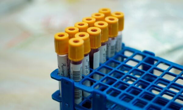 Εγκεφαλικό πριν από τα 60: Μελέτη συνδέει την ομάδα Α με 16% υψηλότερο σχετικό κίνδυνο – Τι σημαίνει στην πράξη