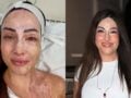 Ιωάννα Παλιοσπύρου: Πέντε ημέρες θεραπειών με laser για τις ουλές – Πώς γίνεται η αποκατάσταση