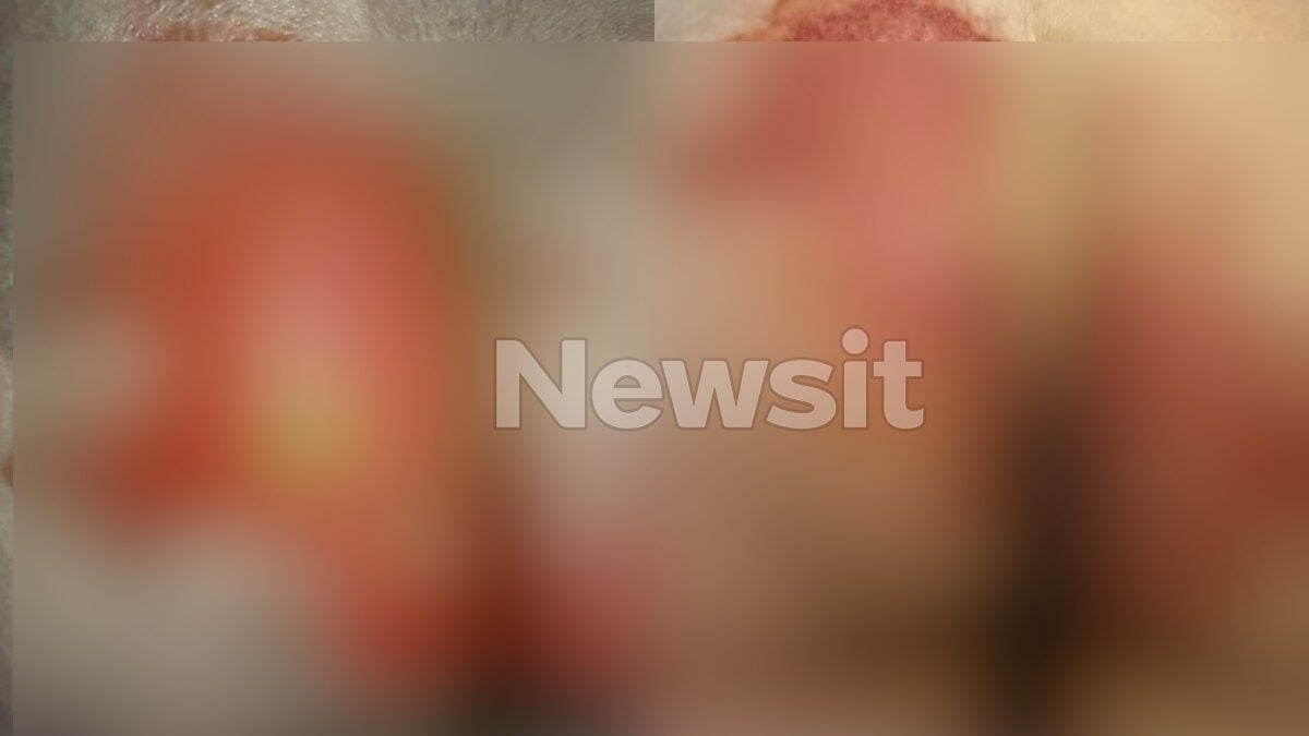 Θεσσαλονίκη: 52χρονη υπέστη χημικά εγκαύματα στα γεννητικά όργανα μετά από εξέταση – «Της έριξαν οξύ και της έλεγαν ότι έχει αλλεργία» 1 Θεσσαλονίκη: 52χρονη υπέστη χημικά εγκαύματα στα γεννητικά όργανα μετά από εξέταση – «Της έριξαν οξύ και της έλεγαν ότι έχει αλλεργία»