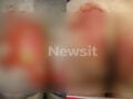 Θεσσαλονίκη: 52χρονη υπέστη χημικά εγκαύματα στα γεννητικά όργανα μετά από εξέταση – «Της έριξαν οξύ και της έλεγαν ότι έχει αλλεργία»
