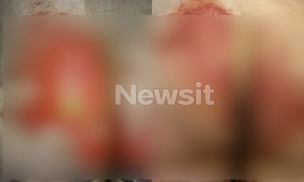 Θεσσαλονίκη: 52χρονη υπέστη χημικά εγκαύματα στα γεννητικά όργανα μετά από εξέταση – «Της έριξαν οξύ και της έλεγαν ότι έχει αλλεργία»