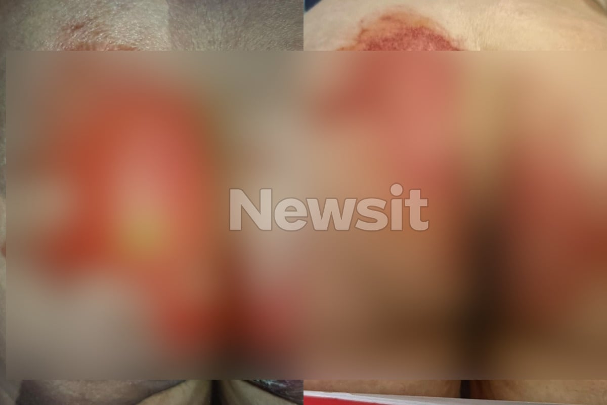 Θεσσαλονίκη: 52χρονη υπέστη χημικά εγκαύματα στα γεννητικά όργανα μετά από εξέταση – «Της έριξαν οξύ και της έλεγαν ότι έχει αλλεργία»